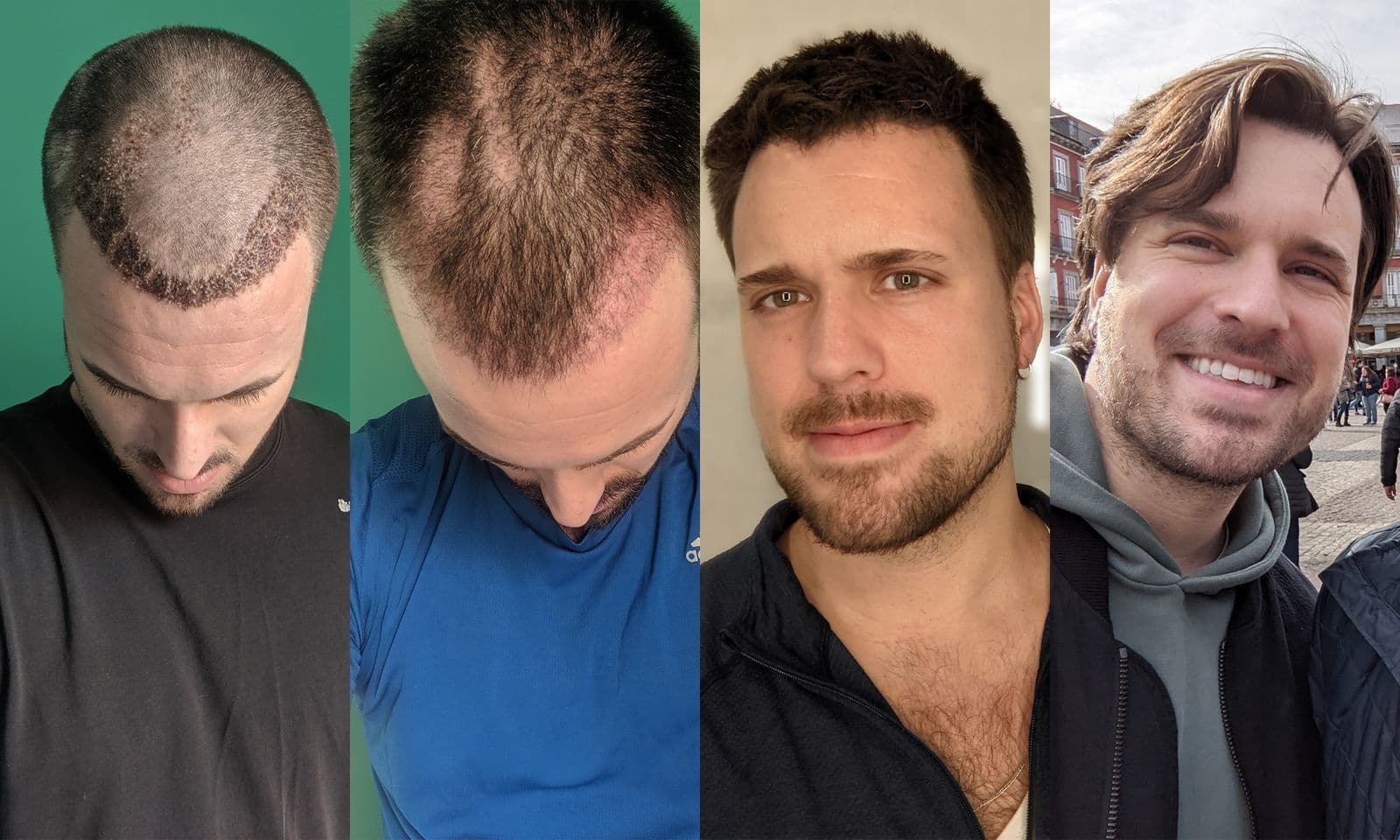 Best Non Surgical Hair Replacement NYC